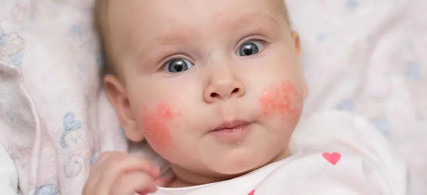 Best strategies to battle baby allergies