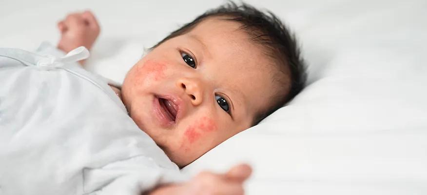 Do Babies Get Acne?