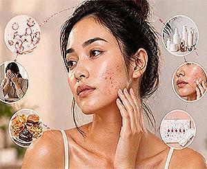 Understanding Adult Acne: Causes, Treatments, Prevention